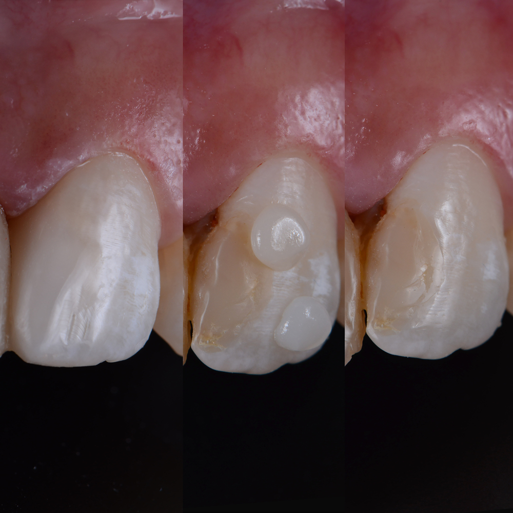 Before, During, and After Dental Fillings, Los Angeles, CA, Culver City, CA, Marina Del Ray, CA