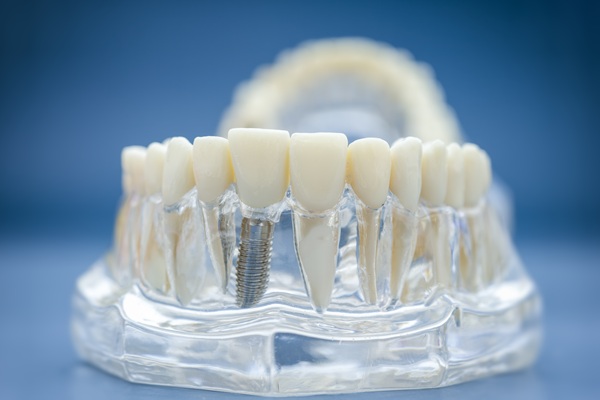 Can A Dental Implant Fall Out?
