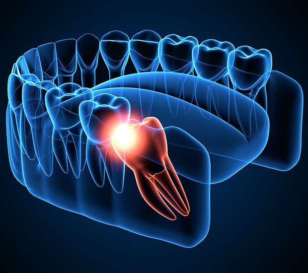 Los Angeles Wisdom Teeth Extraction